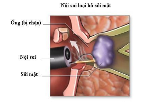 Bệnh sỏi ống mật gây nên những biến chứng có hại như thế nào?