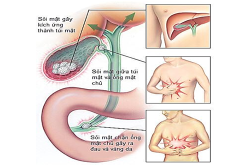 Sỏi ống mật có rất nhiều biến chứng nguy hại đến sức khỏe