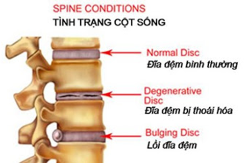 Bệnh thoái hóa cột sống là gì, phương pháp điều trị như thế nào?