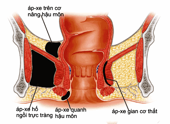 Nên kiêng khem gì khi bị căn bệnh áp xe hậu môn
