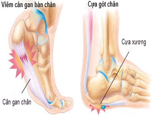 Điều trị bệnh đau gót chân