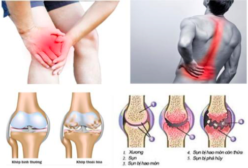 Bệnh về xương khớp