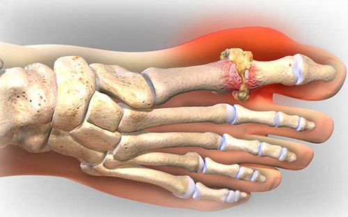 Tìm hiểu về cách điều trị bệnh Gout hiệu quả