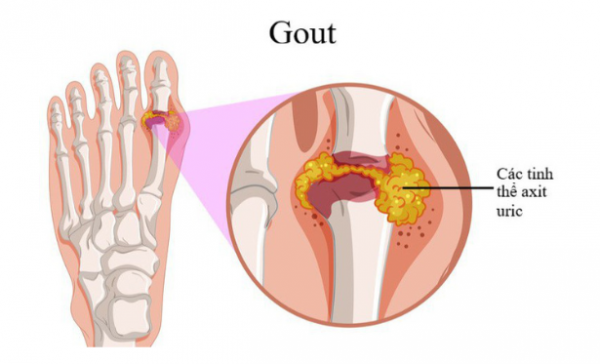 Bệnh gút đa phần là cấp tính, không có triệu chứng báo trước
