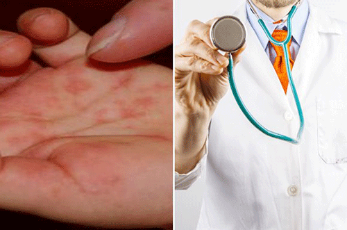 Gặp bác sĩ để khám nếu nghi ngờ mắc bệnh hồng ban nút Gặp bác sĩ để khám nếu nghi ngờ mắc bệnh hồng ban nút