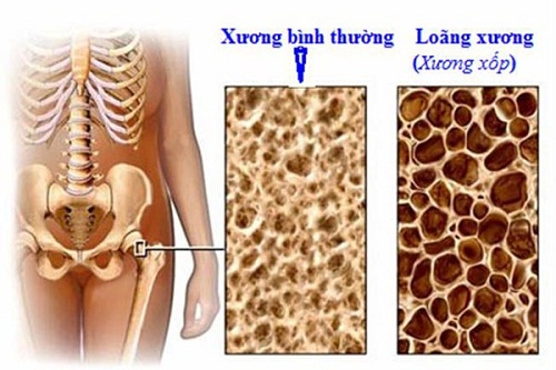 benh loang xuong 8