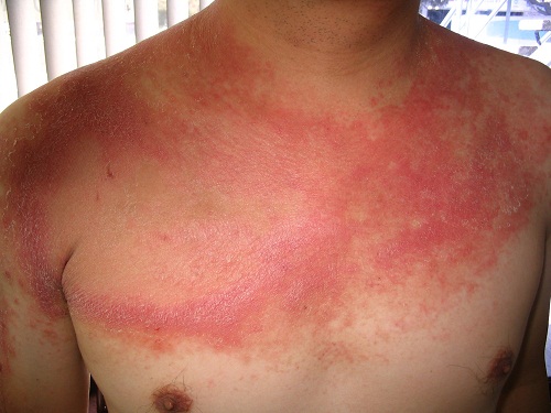 benh-lupus-ban-do