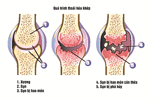 benh-thoai-hoa-khop