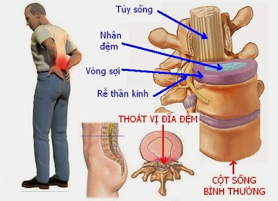 Bệnh thoát vị đĩa đệm có hiểm nguy không?