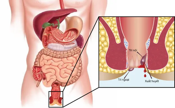 bệnh trĩ nội độ 1