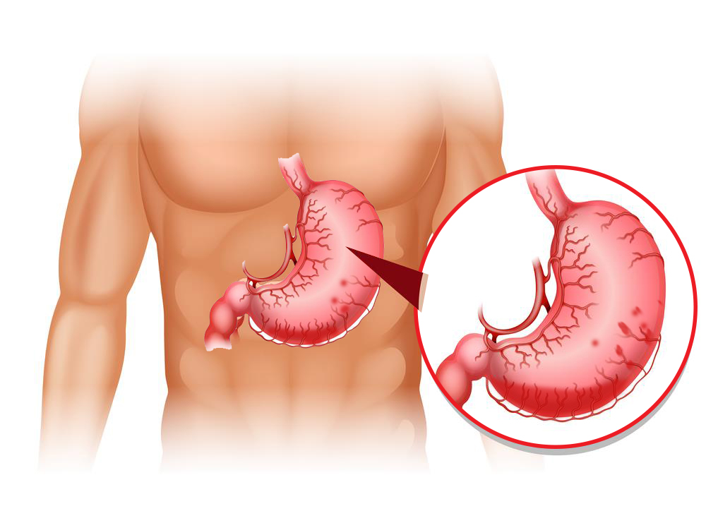 Xuất huyết dạ dày rất nguy hiểm không nên chủ quan
