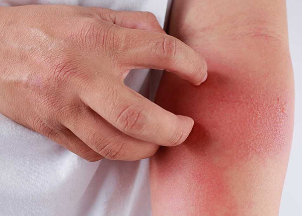 Điều dưỡng chỉ ra cách điều trị bệnh eczema và những yếu tố gây nên