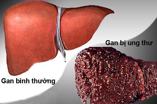 Sau những ca ghép gan có phải đều thành công không?