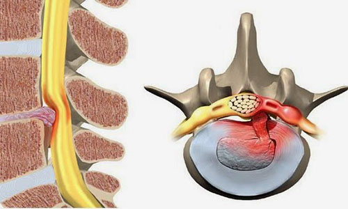 Cùng chuyên gia tìm hiểu thoát vị đĩa đệm mất nước là gì?
