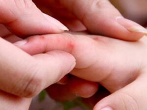 chan tay mieng dau hieu o tay tre