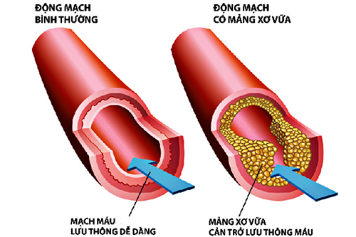 Chuyên gia điều dưỡng cho biết những nguyên nhân gây rối loạn mỡ máu