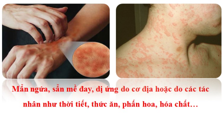 DEP thuốc đặc trị bệnh ghẻ