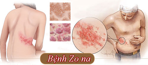 dieu-tri-benh-zona