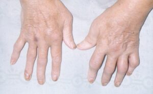 dieu tri viem khop vay nen 1 1