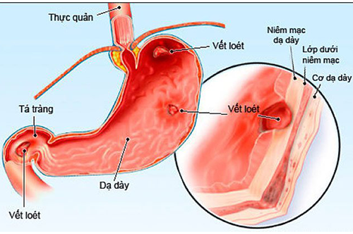 Xác định mình đã bị viêm loét dạ dày bằng phương pháp kiểm tra đơn giản