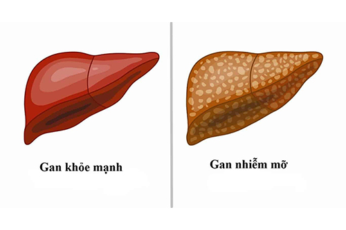 gan nhiem mo 4