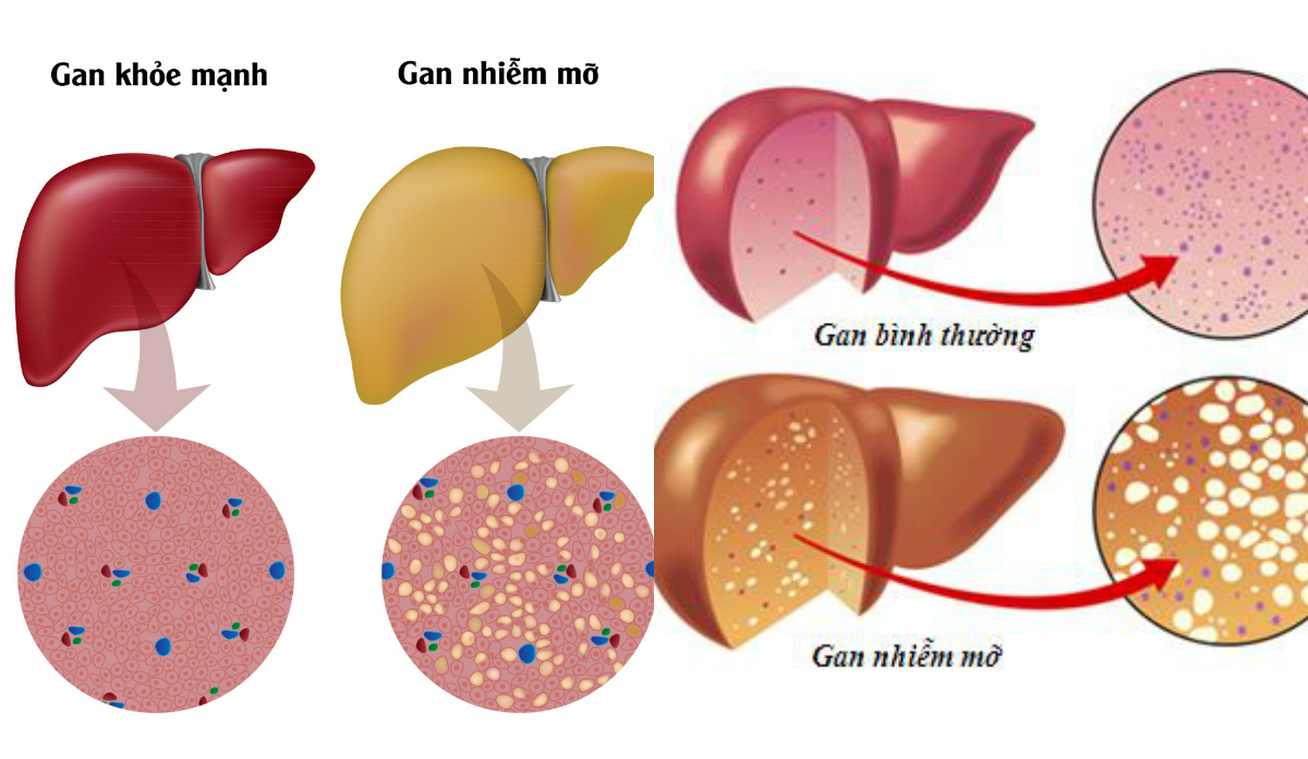 gan-nhiem-mo-do