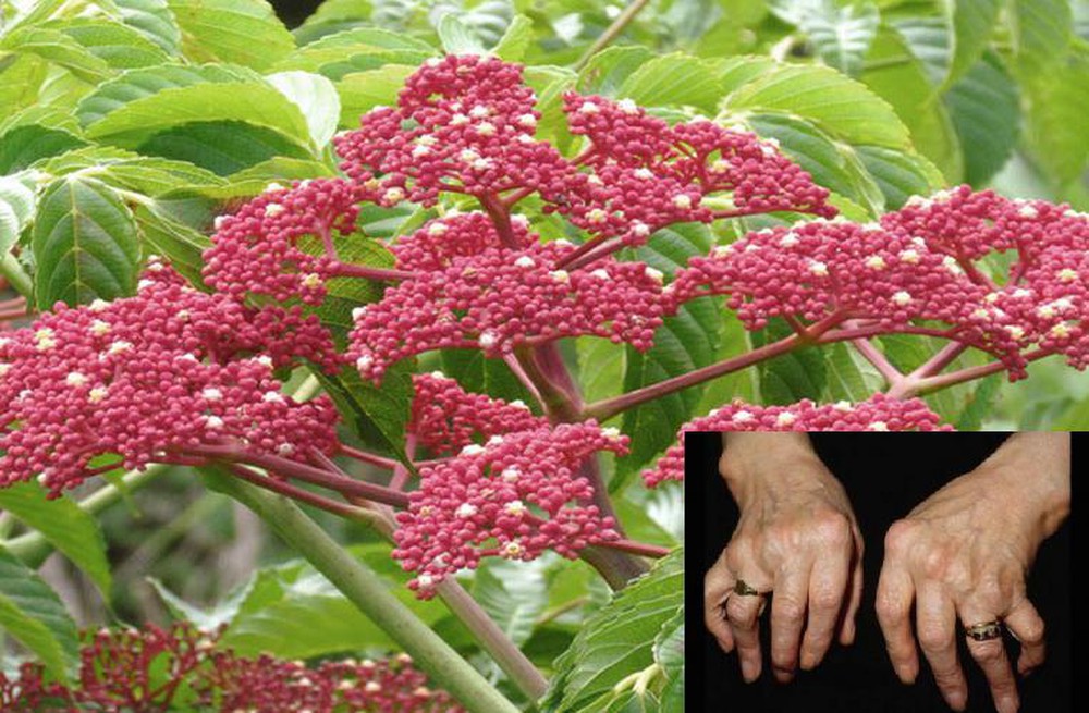 Điều trị thoái hóa khớp gối bằng cây gối hạc theo phương pháp Đông y