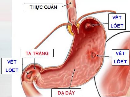 benh-sinh-va-dieu-tri-loet-da-day-ta-trang