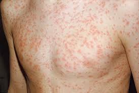 Rubella