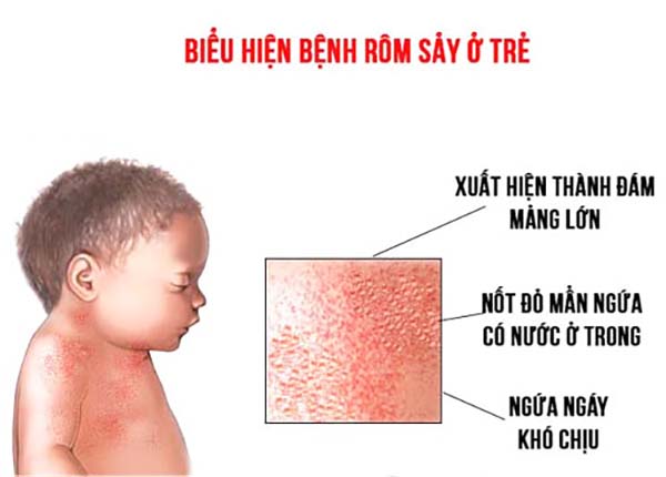 kem tri rom say cho be 4