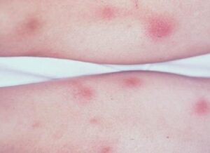 Kiến thức về triệu chứng và chẩn đoán bệnh hồng ban nút