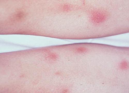 Kiến thức về triệu chứng và chẩn đoán bệnh hồng ban nút