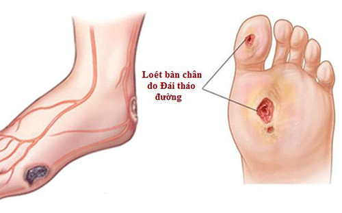 Đừng chủ quan với biến chứng loét bàn chân ở bệnh nhân tiểu đường