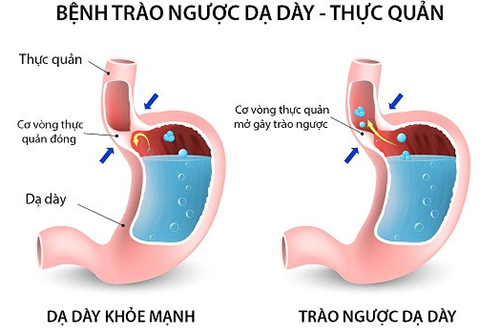 Một số triệu chứng của bệnh trào ngược dạ dày chớ nên coi thường