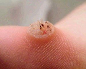 Mụn cóc là gì ?