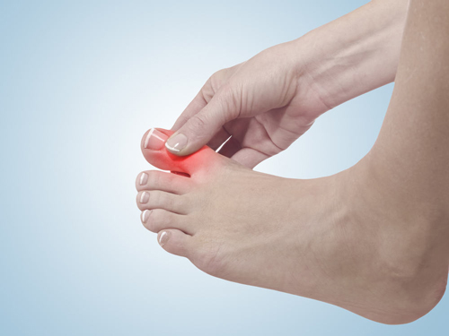 Tìm hiểu và nguyên nhân gây nên bệnh gout