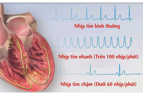 Những triệu chứng thường gặp của bệnh rối loạn thần kinh tim