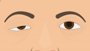 nhuoc co nguyen nhan bieu hien va cach chua tri1 800x450 1 1