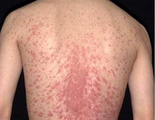 Các biện pháp chữa trị nổi mề đay