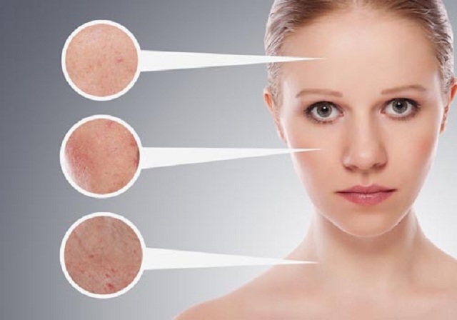 Sạm da: Nỗi ám ảnh của phụ nữ