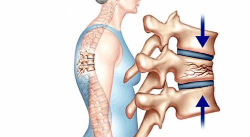 Loãng xương gây tác động xấu đến xương người bệnh