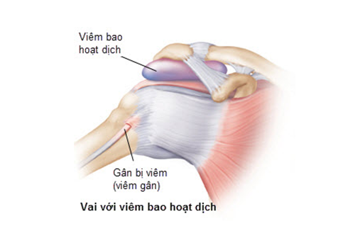 Tìm hiểu bệnh viêm bao hoạt dịch và phương pháp điều trị là gì?