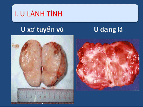 Hình ảnh u vú lành tính