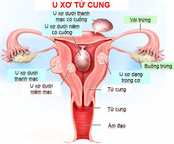 Dấu hiệu và biến chứng nguy hiểm của u xơ tử cung