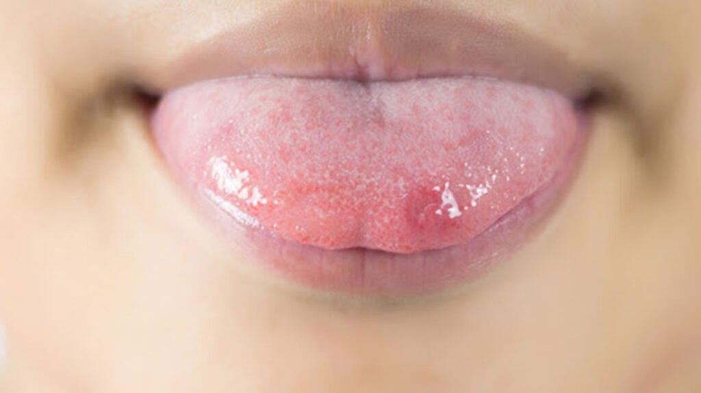 Đột quỵ tim và đột quỵ não có giống nhau không? 1 ung thu luoi va nhiet mieng 1 1