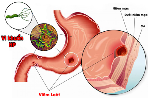 Viêm loét dạ dày do vi khuẩn Hp và biến chứng của bệnh ?