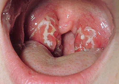viem amidan qua phat la gi trieu chung 4