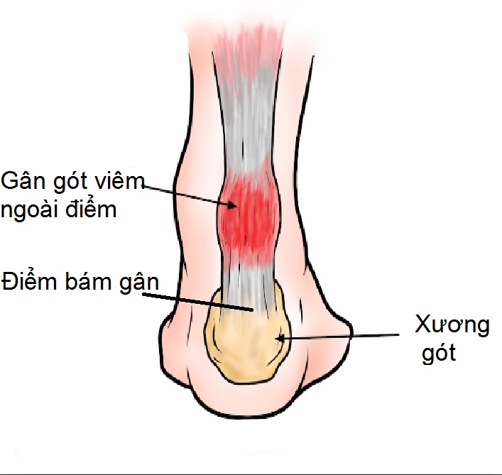 Triệu chứng bệnh viêm chỗ bám xương của gân gót