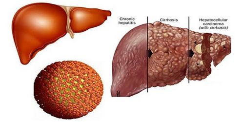 Hiểm họa khôn lường do viêm gan B