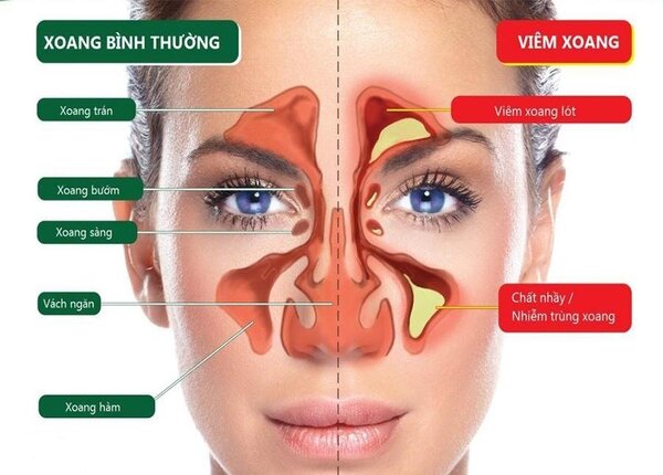 viem mui xoang cap 1 1
